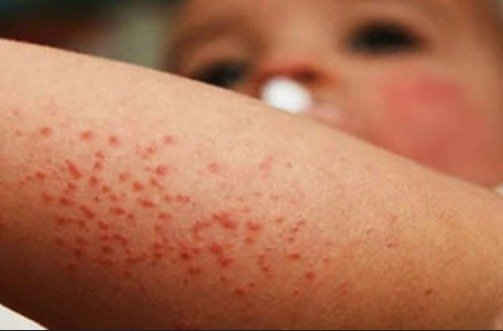 Campeche registra tres casos confirmados de sarampión y mantiene 31 contagios en estudio